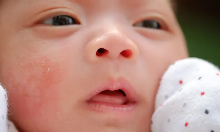 baby acne on face 