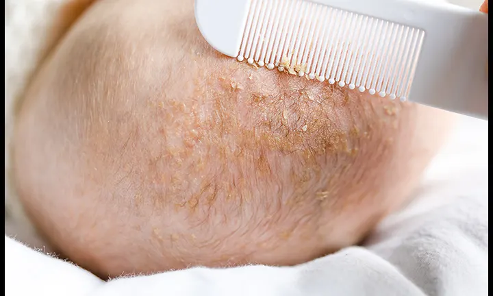 Cradle Cap