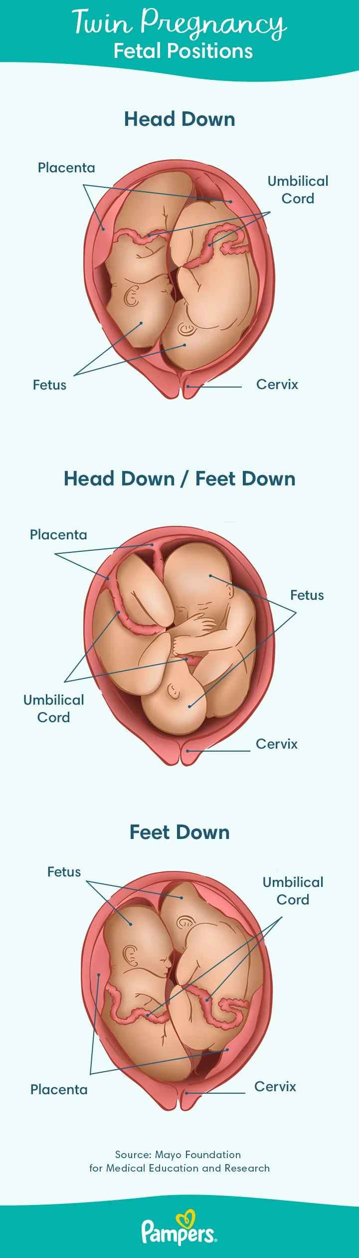 Third trimester twins in womb